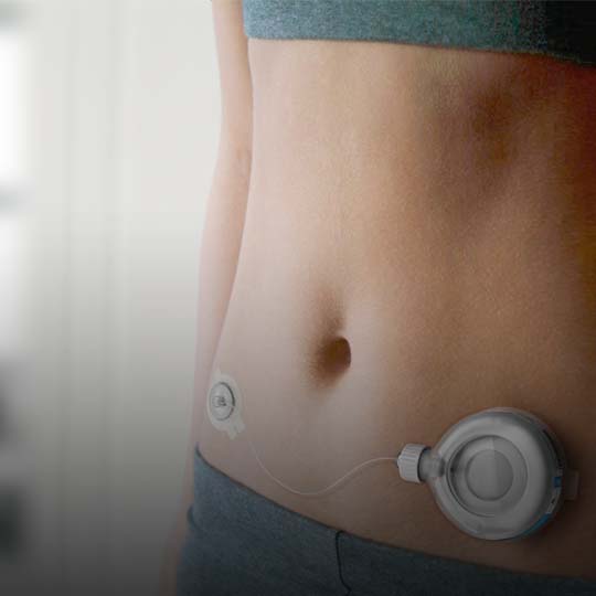 Close-up of a person's abdomen with a medical device attached. The device is connected via tubing to a small, round reservoir. It appears to be a continuous glucose monitor or insulin pump.