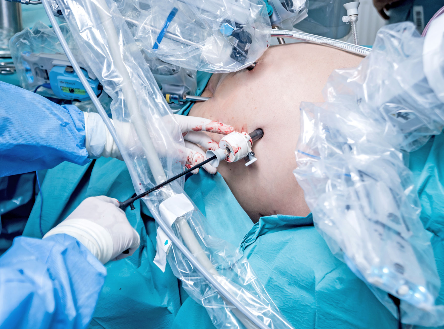 surgeon-performing-laparoscopic-surgery